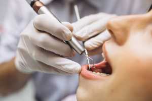 Ce sunt extracțiile dentare