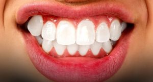 Cum să îți recapeți încrederea după accidente dentare și uzura danturii