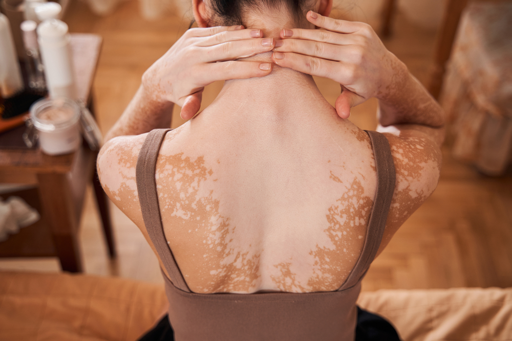 vitiligo